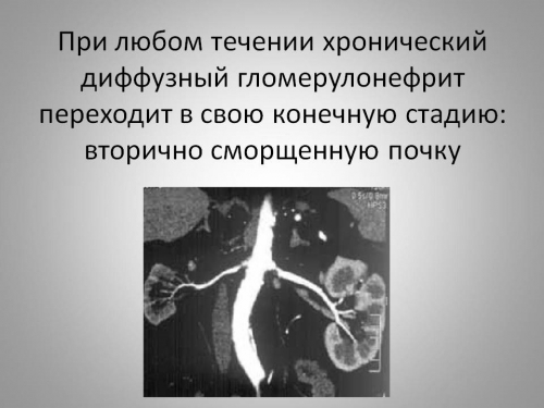Хронический гломерулонефрит с мочевым синдромом лечение