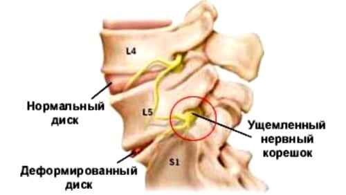 Поясничный остеохондроз с корешковым синдромом что это