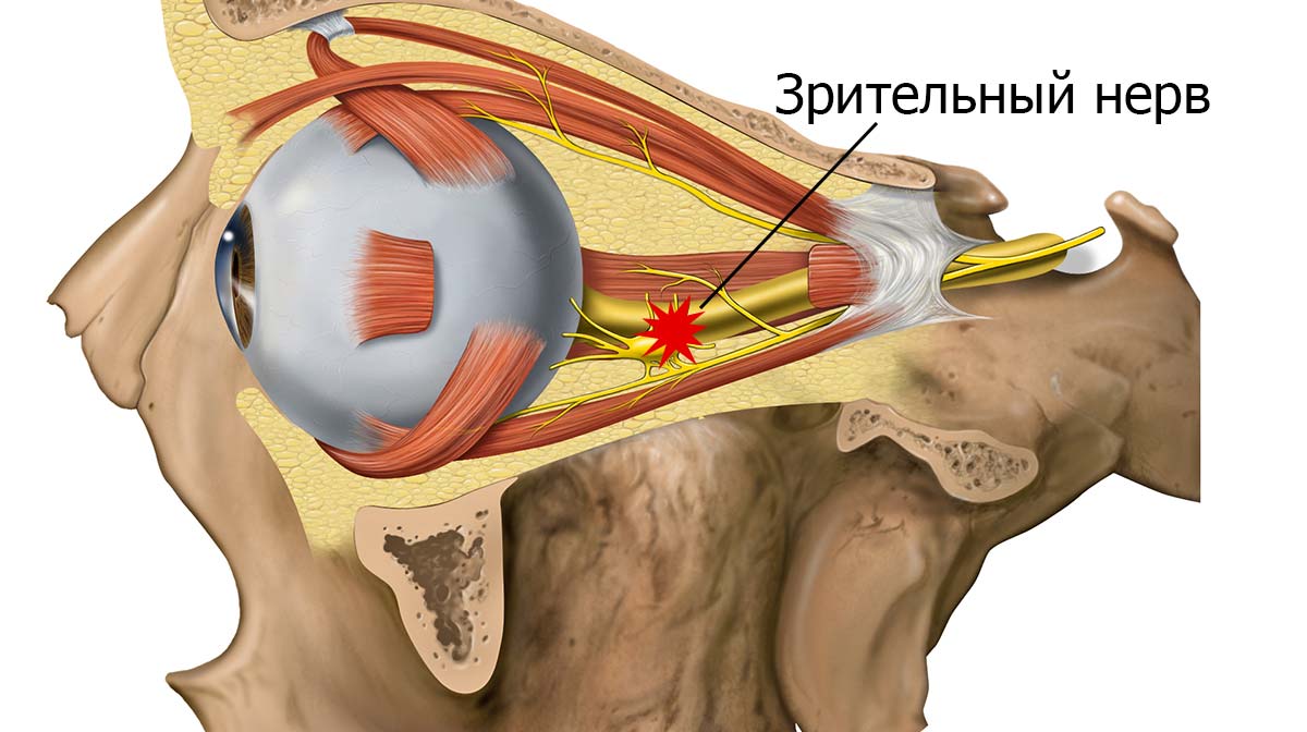 угнетение деятельности зрительного нерва