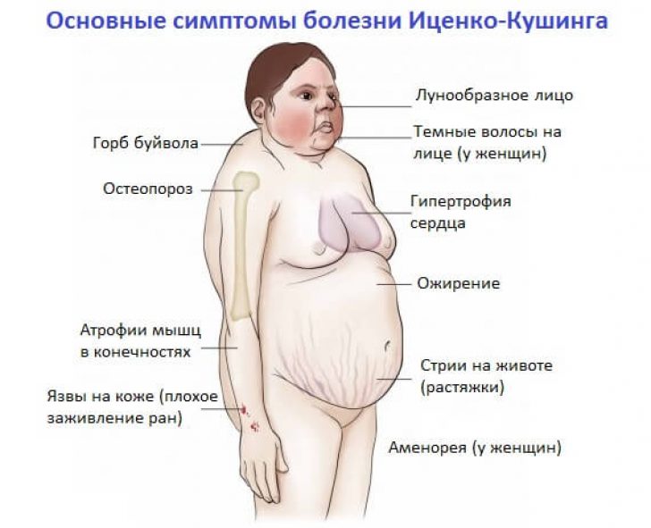 Как выглядит человек при синдроме Кушинга Как выглядит человек при синдроме Кушинга