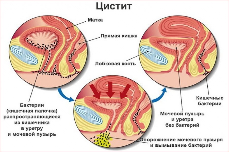 Цистит