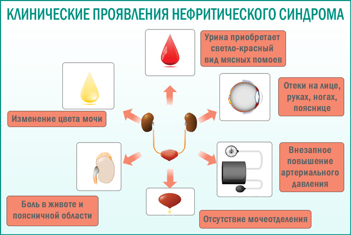 Клинические проявления нефритического синдрома Нефритический синдром: клинические проявления