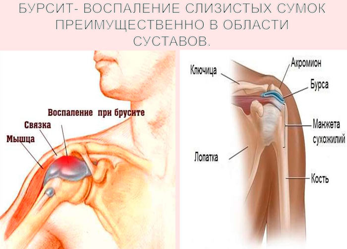 Бурсит плеча фото