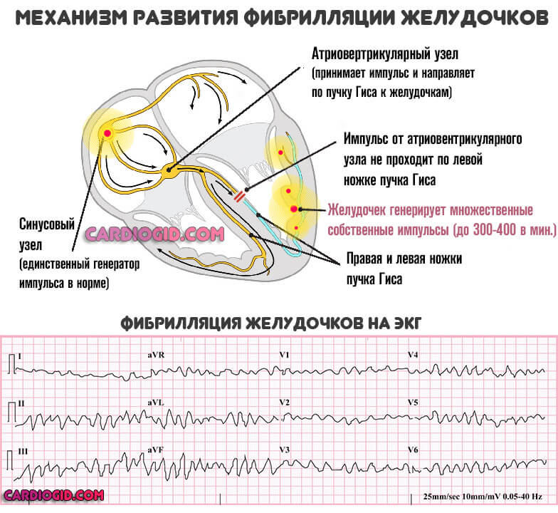 фибрилляция-желудочков