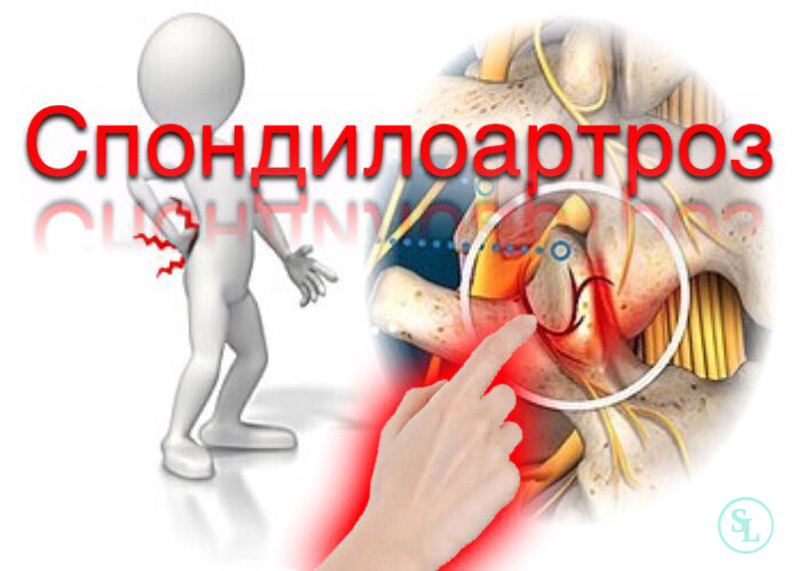 Спондилоартроз с хроническим болевым синдромом