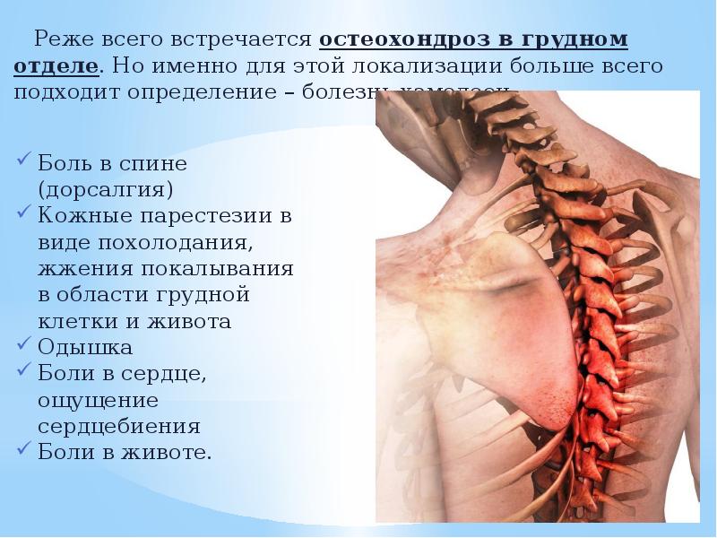Поясничный остеохондроз с корешковым синдромом что это