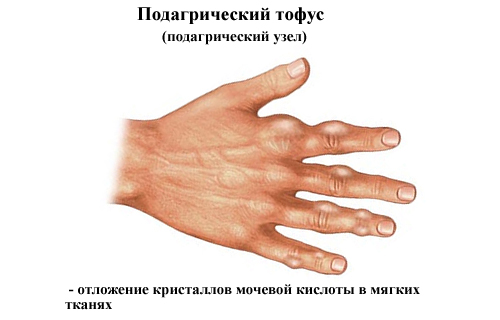 Подагра как осложнение Подагра как осложнение