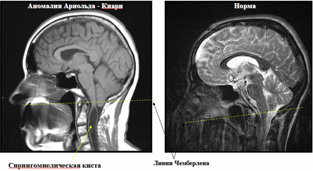 Результаты МРТ при аномалии Арнольда Киари с сирингомиелической кистой и в норме Аномалия киари код мкб