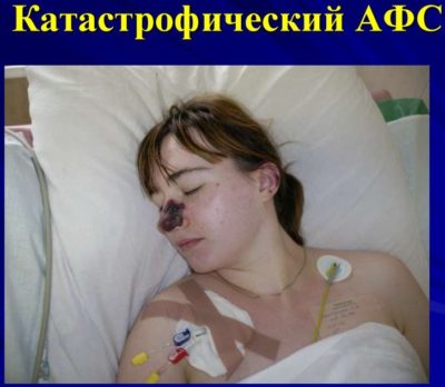 Фосфорно липидный синдром при беременности