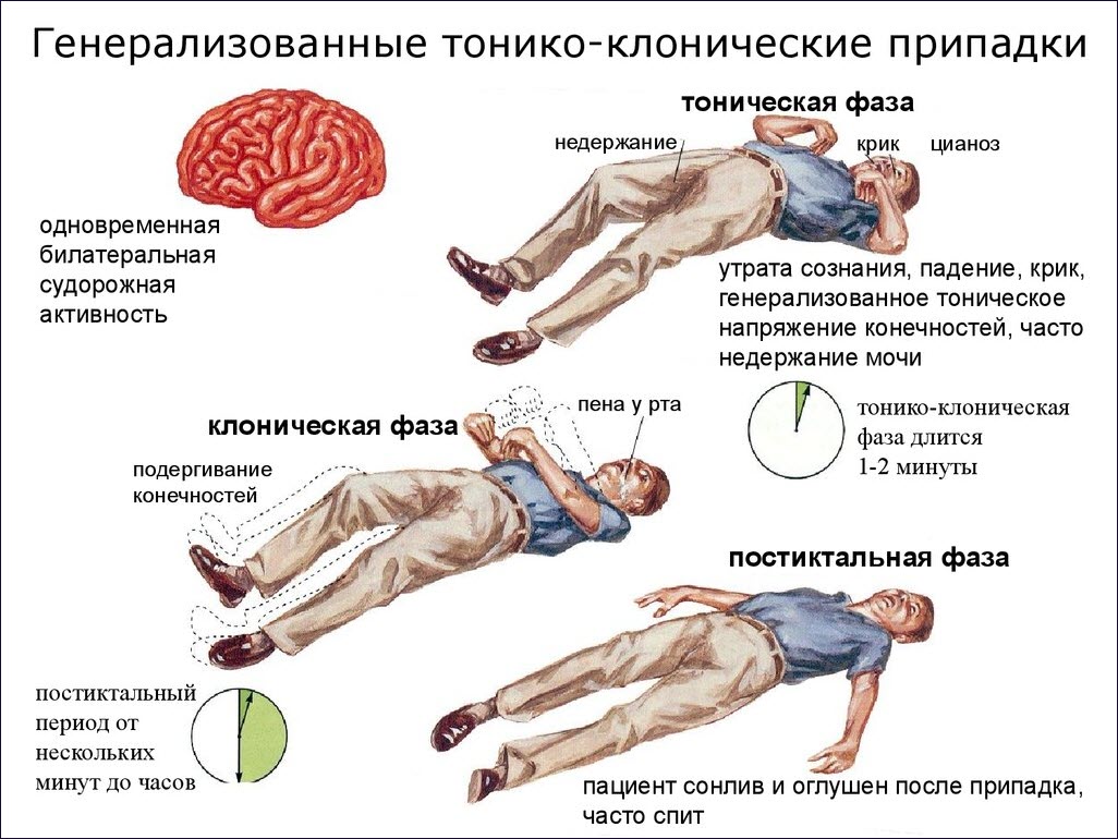 Судорожный приступ