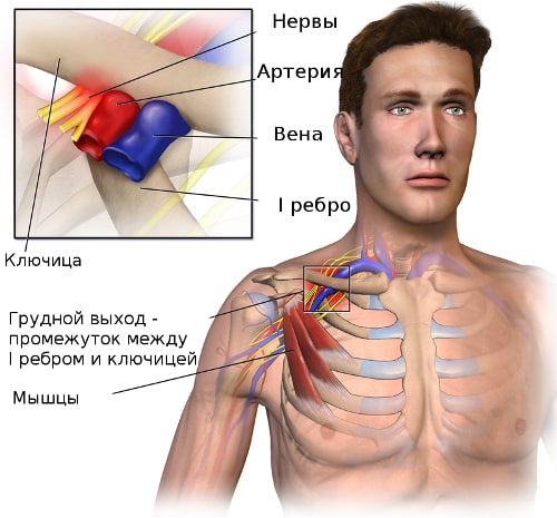 Схема формирования синдрома грудного выхода Схема формирования синдрома грудного выхода
